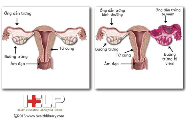 Căn bệnh nhiễm trùng không có triệu chứng rõ ràng này hoàn toàn có thể khiến bạn bị vô sinh - Ảnh 2.