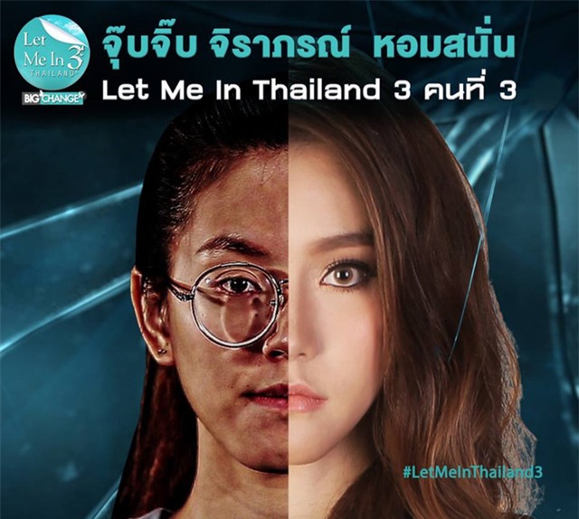 Cô gái hàm lệch, miệng méo thay đổi ấn tượng sau thẩm mỹ khiến mẹ đẻ khóc nghẹn vì xúc động-2