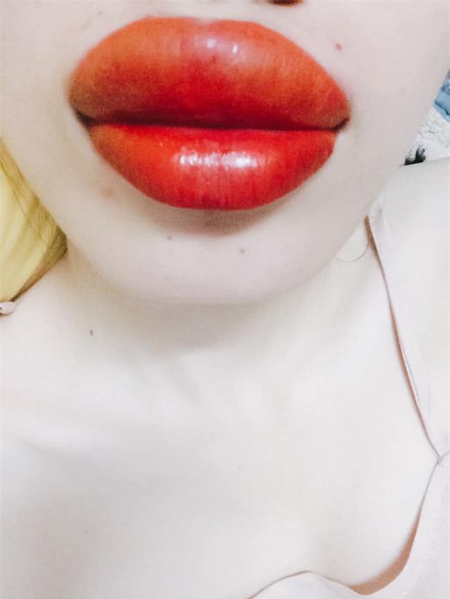 Thẩm mỹ viện quảng cáo phun môi không sưng không đau, cô gái trẻ háo hức đi làm và cái kết đắng ngắt - Ảnh 1.