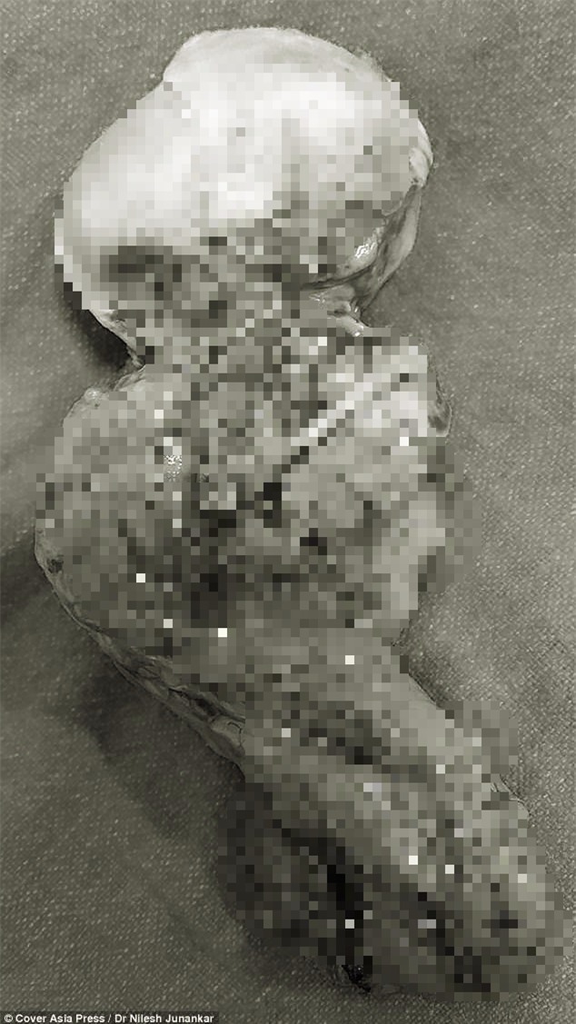 15 năm sau khi phá thai, bà mẹ sốc nặng khi phát hiện thứ này trong bụng - Ảnh 3.