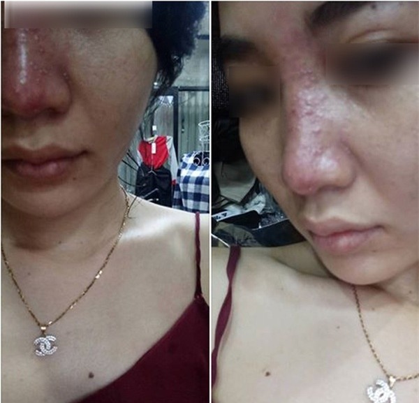 Tiêm filler nâng mũi tưởng ngon ăn mà 1 đống trường hợp biến chứng thế này, ai còn muốn làm nữa