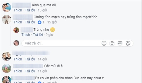 Tiêm filler nâng mũi tưởng ngon ăn mà 1 đống trường hợp biến chứng thế này, ai còn muốn làm nữa