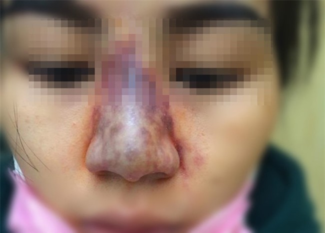 Tiêm filler nâng mũi tưởng ngon ăn mà 1 đống trường hợp biến chứng thế này, ai còn muốn làm nữa