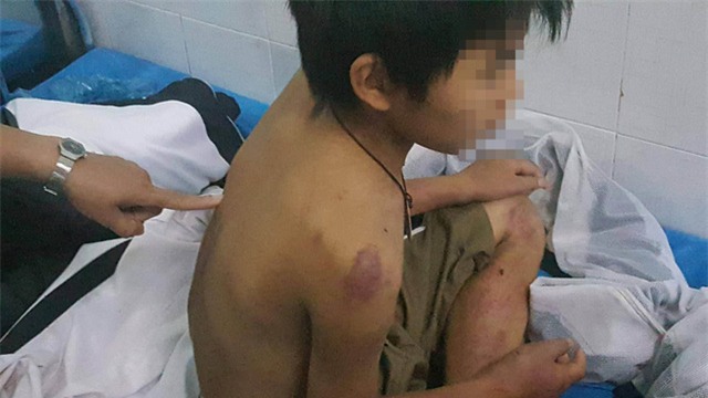 Cậu bé 11 tuổi nghi bị bố đánh đa chấn thương