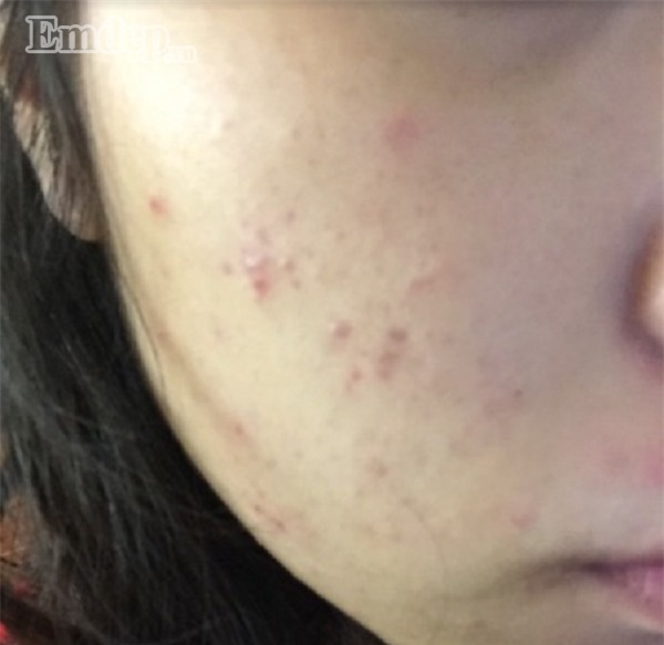 Đây chính là ‘thần dược’ giúp nàng 9x từ mặt chi chít mụn trở nên trắng bóc, mịn màng.