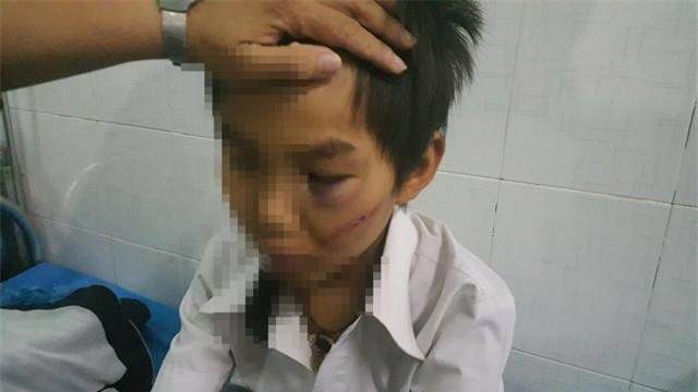 be trai 11 tuoi bi bo danh da chan thuong: "chau van xin nhung bo van danh" - 1