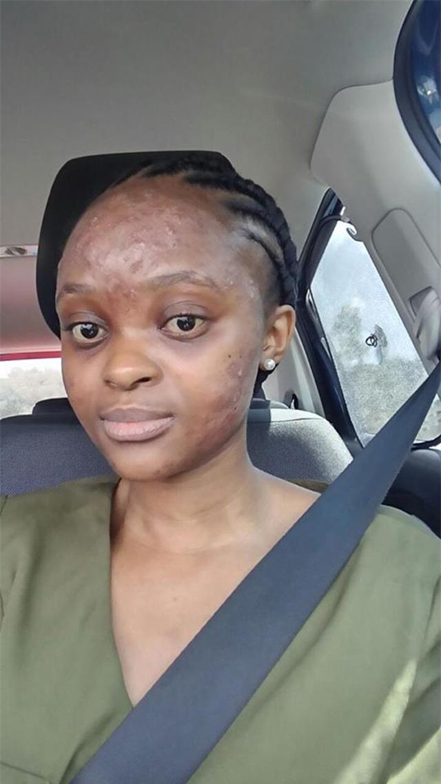 chu quan voi nhung vet mun trung ca tren mat, co gai suyt phai tra gia bang ca tinh mang - 2