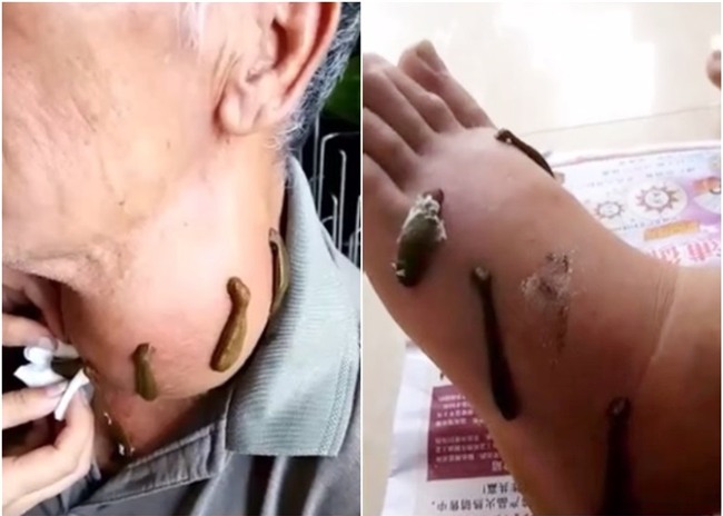 chữa bệnh bằng đỉa,đỉa hút máu,Trung Quốc