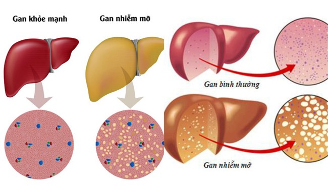 Mỡ máu cao gây ra 3 loại bệnh nguy hiểm, hiểm họa bắt đầu từ 4 thói quen nhiều người mắc - Ảnh 3.
