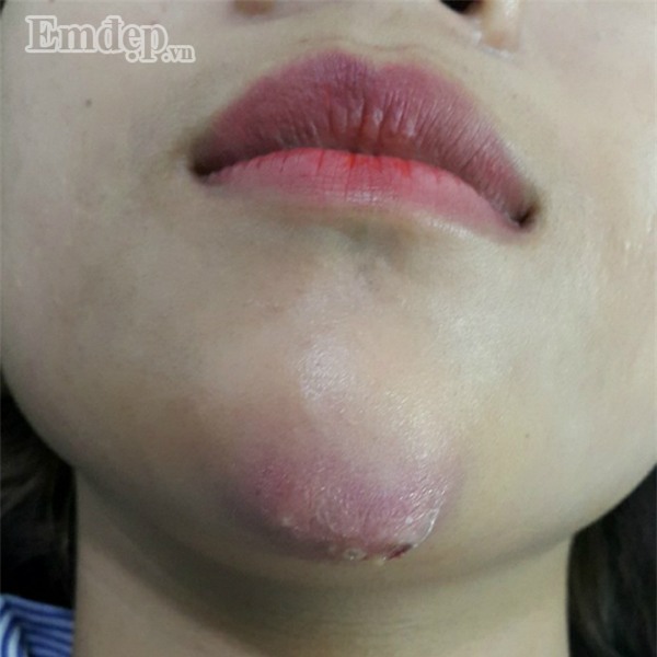 Bác sĩ thẩm mỹ rùng mình hút ra hai mươi cốc mủ từ ngực nạn nhân biến chứng nặng sau khi tiêm Filler “rởm” (P.2)