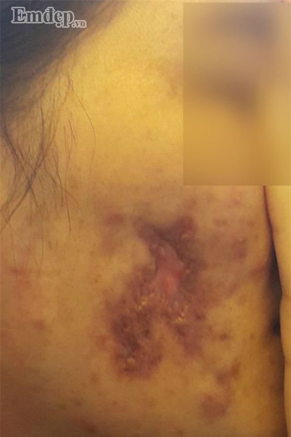 Bác sĩ thẩm mỹ rùng mình hút ra hai mươi cốc mủ từ ngực nạn nhân biến chứng nặng sau khi tiêm Filler “rởm” (P.2)