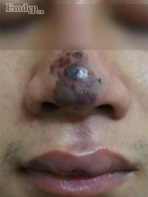 Bác sĩ thẩm mỹ rùng mình hút ra hai mươi cốc mủ từ ngực nạn nhân biến chứng nặng sau khi tiêm Filler “rởm” (P.2)