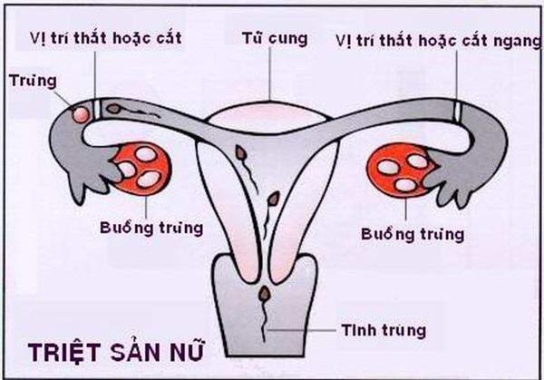 ha noi: ba me 3 con ngo ngang phat hien mang thai du da triet san hon 1 nam truoc - 2