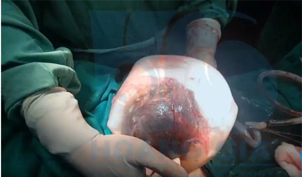 Clip: Em bé số hưởng chào đời trong bọc điều hy hữu tại Việt Nam, 80.000 ca mới có một - Ảnh 2.