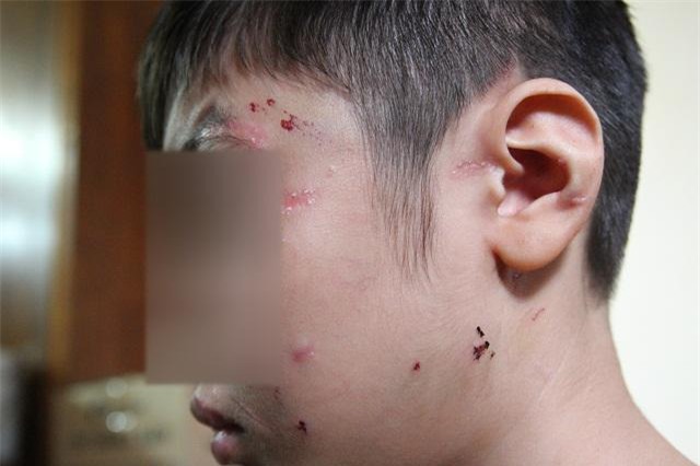 nhung vet thuong tren co the be trai 10 tuoi bi bao hanh ai nhin thay cung xot xa - 1