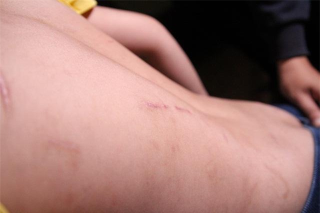 nhung vet thuong tren co the be trai 10 tuoi bi bao hanh ai nhin thay cung xot xa - 4