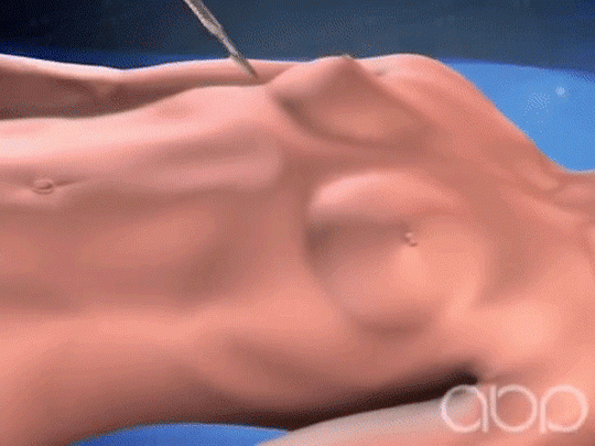 quyet dinh nang nguc bang phuong phap noi soi dat tui nguc, can luu y nhung dieu gi? - 6