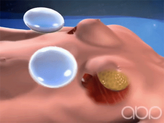 quyet dinh nang nguc bang phuong phap noi soi dat tui nguc, can luu y nhung dieu gi? - 8