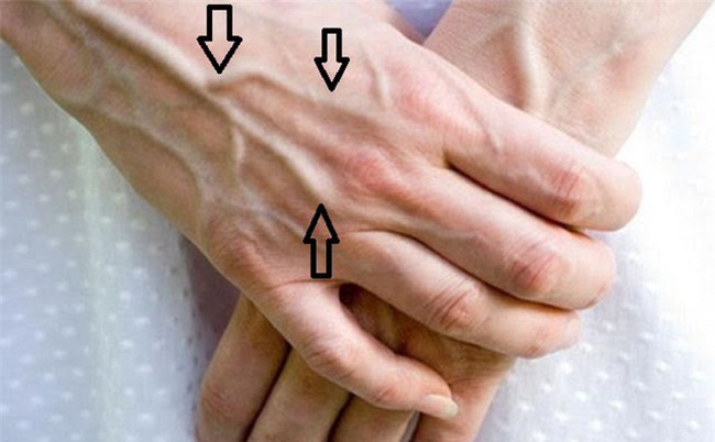 Nên làm gì khi thấy những gân xanh nổi trên người: Giáo sư Anh chia sẻ cách xử lý