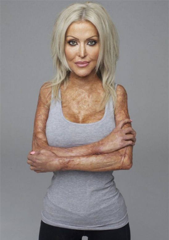 Từng bị đánh ghen, thiêu sống đến mức hủy hoại cả dung nhan, 5 năm sau người phụ nữ này đã xinh đẹp trở lại - Ảnh 8.