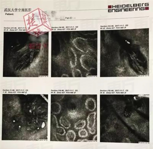 Hơn 4 năm liền không giặt gối, người phụ nữ đi khám và phát hiện hơn 100 con rận trong mi mắt - Ảnh 2.