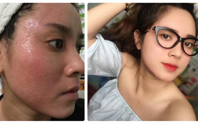 Bôi rượu thuốc bắc để 