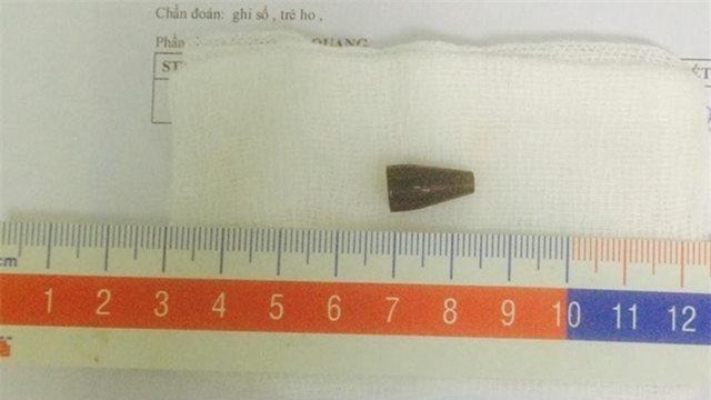 ngam but bi khi dang hoc bai, be trai 8 tuoi bi dau but chui tot vao duong tho - 1