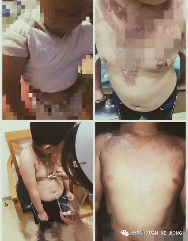 Chạy nhảy trong nhà hàng, bé trai giãy dụa đau đớn khi bị cả nồi nước lẩu đổ vào người - Ảnh 3.