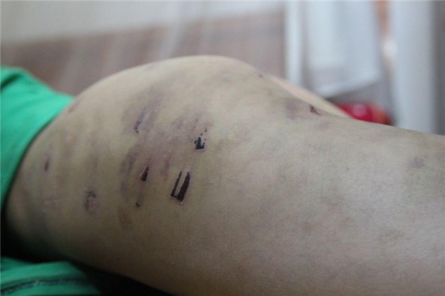 ha noi: be trai 9 tuoi bi diem kem, bo dung day dien bao hanh da man - 2