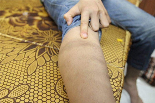 ha noi: be trai 9 tuoi bi diem kem, bo dung day dien bao hanh da man - 5