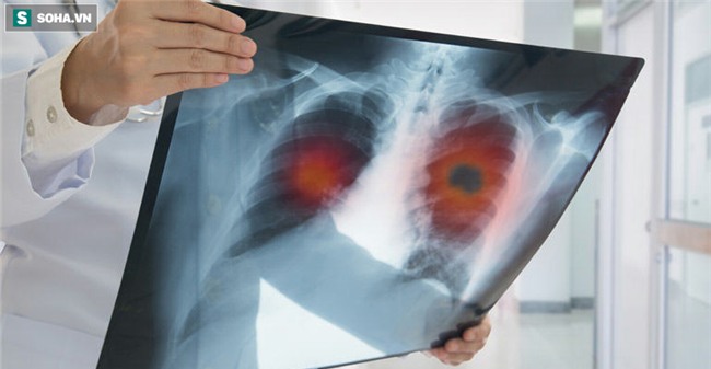 1 triệu chứng cảnh báo ung thư phổi giai đoạn đầu: Phát hiện sớm 90% cơ hội chữa khỏi bệnh - Ảnh 1.