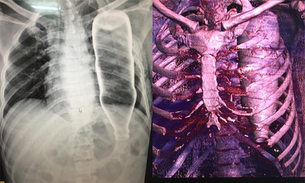 ca bệnh hy hữu,xuyên tim,vẹo cột sống,sống lại