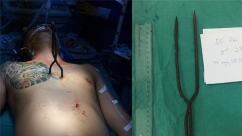 ca bệnh hy hữu,xuyên tim,vẹo cột sống,sống lại