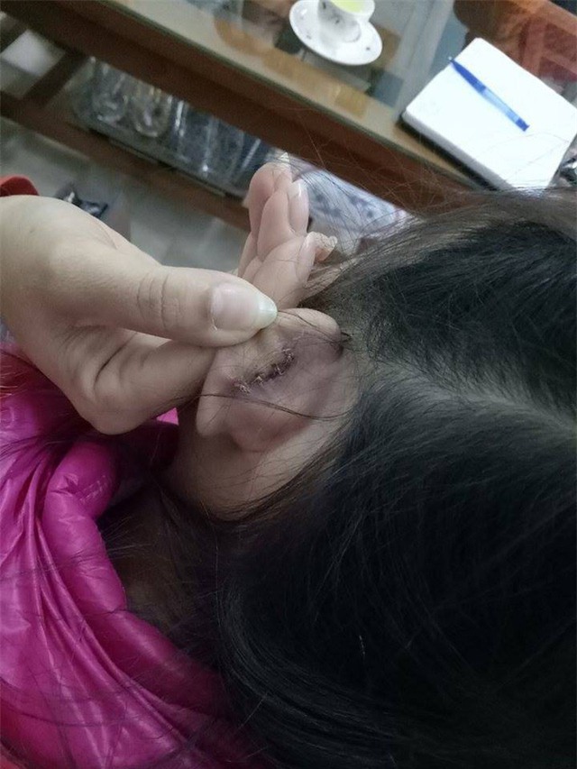 Vết rách phải khâu 4 mũi của học sinh Q.A sau khi bị cô giáo xách tai