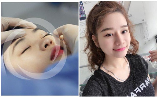 nhat ki cat mi mat cua co nang 9x tung lo so mat se bi "tron" sau phau thuat! - 4