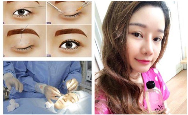 nhat ki cat mi mat cua co nang 9x tung lo so mat se bi "tron" sau phau thuat! - 5