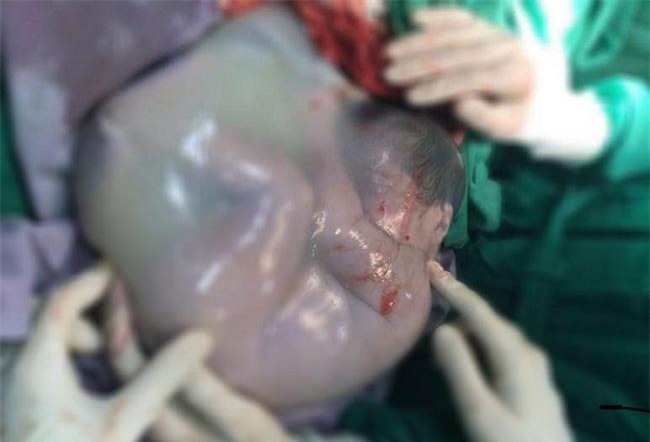 tp.hcm: be gai song sinh ra khoi bung me van con nguyen trong boc oi, 80.000 ca moi co mot - 1