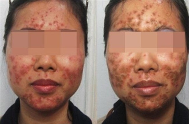 TIN PHẢI ĐỌC: Công bố danh sách những loại kem dưỡng trắng hủy hoại da không kém gì kem trộn