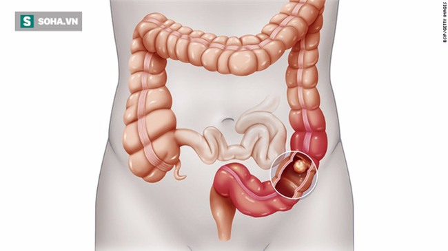 Cô gái trẻ bị ung thư giai đoạn cuối, bác sĩ nói điều mà bất kỳ ai cũng phải giật mình - Ảnh 3.