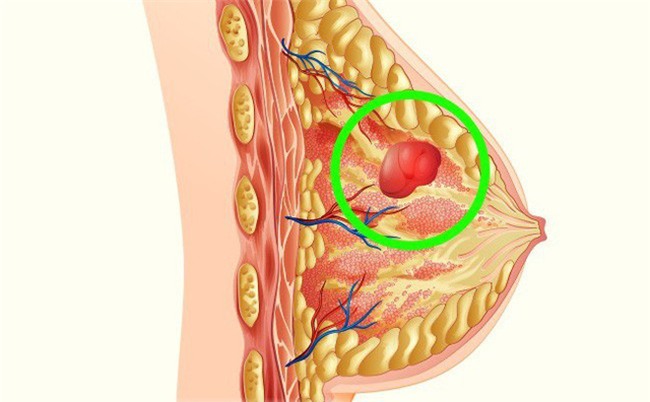 Uống nhiều sữa có gây ung thư? Đây là câu trả lời của Quỹ nghiên cứu Ung thư thế giới
