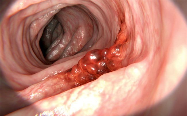 Mắc ung thư giai đoạn muộn, tiến sĩ Việt tự đúc kết 4 sai lầm hàng ngày gây nên bệnh