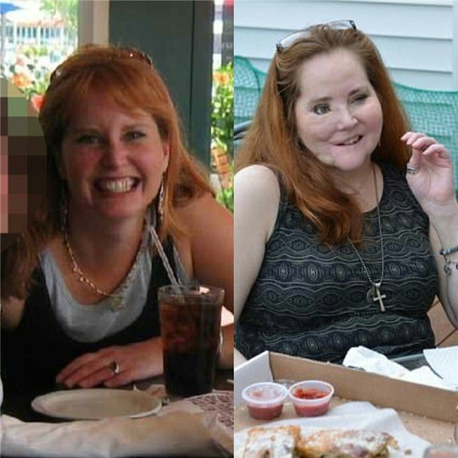 Dùng súng tự sát bất thành khiến dung mạo bị hủy hoại, người phụ nữ trải qua 49 cuộc phẫu thuật để làm lại cuộc đời - Ảnh 1.