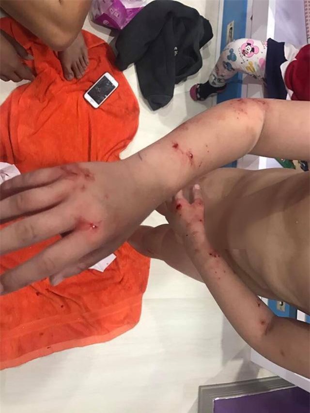 Bé trai 7 tuổi khóc thét khi kính cường lực nhà tắm bỗng dưng phát nổ