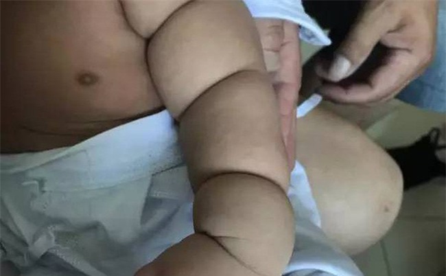 Con mới sinh tay chân đã có nhiều ngấn, bố toát mồ hôi khi bác sĩ nói để muộn phải cắt bỏ