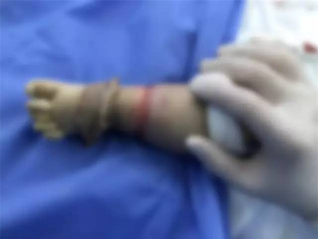 Con mới sinh tay chân đã có nhiều ngấn, bố toát mồ hôi khi bác sĩ nói để muộn phải cắt bỏ - Ảnh 6.