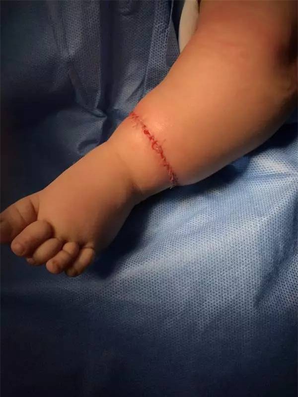 Con mới sinh tay chân đã có nhiều ngấn, bố toát mồ hôi khi bác sĩ nói để muộn phải cắt bỏ - Ảnh 7.