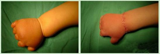 Con mới sinh tay chân đã có nhiều ngấn, bố toát mồ hôi khi bác sĩ nói để muộn phải cắt bỏ - Ảnh 8.