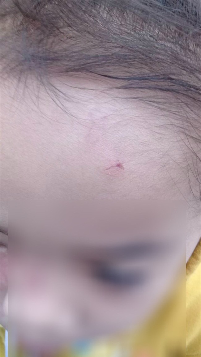 Bé gái 4 tuổi bị bạo hành ở Mầm Xanh tiếp tục có dấu hiệu bị đánh đập ở cơ sở giữ trẻ mới - Ảnh 4.