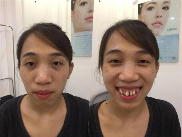 chi tien ti vao phau thuat tham my, va day la nhung man "hoa thien nga" gay chan dong 2017 - 4