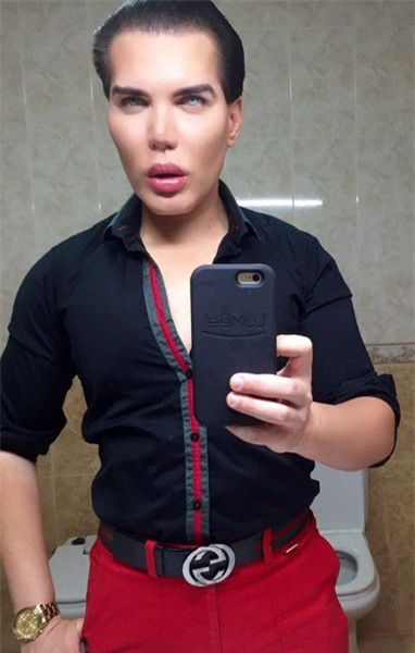 Tiêm filler căng da mặt quá tay, da mặt búp bê Ken phồng rộp như bị bỏng, mũi bị thủng một lỗ - Ảnh 2.